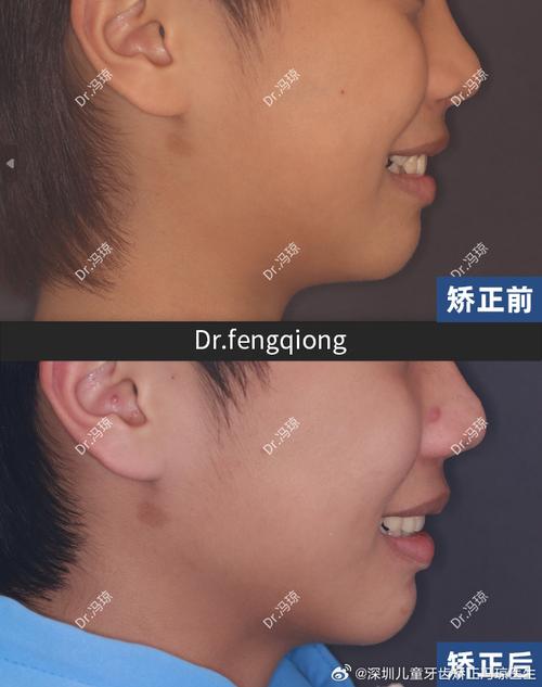 12岁正畸要多久-图2