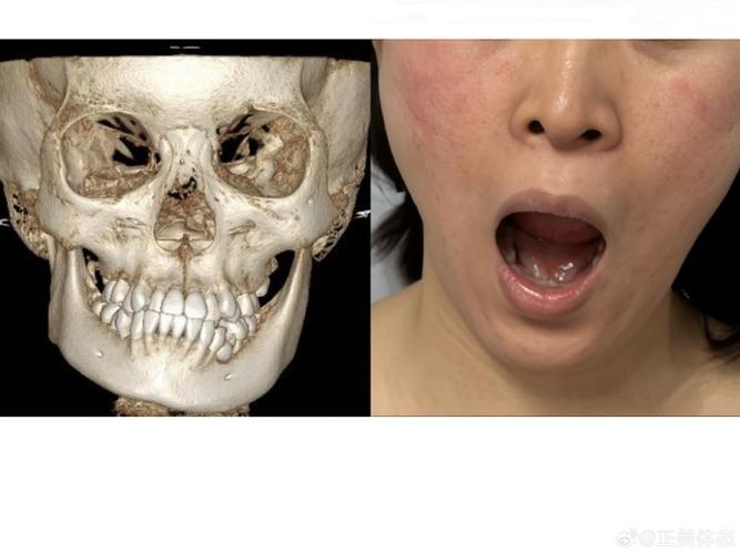 正畸牙齿下巴会歪-图2