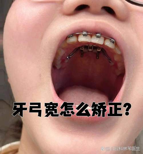 牙弓窄做不了正畸-图1