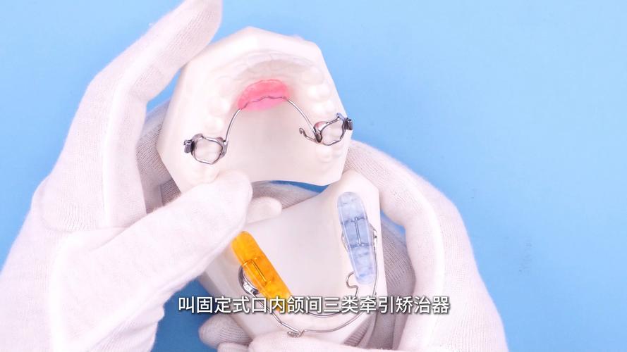口腔正畸3类牵引-图2