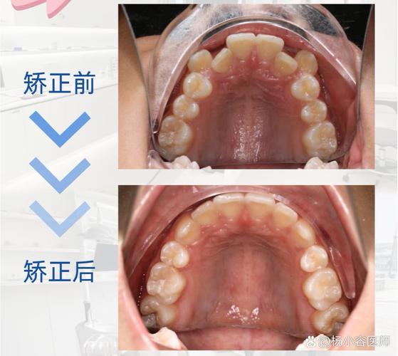 不拔牙正畸可行吗?不拔牙矫正的适用人群与效果解析?-图3 不拔牙正畸可行吗?不拔牙矫正的适用人群与效果解析?-图3