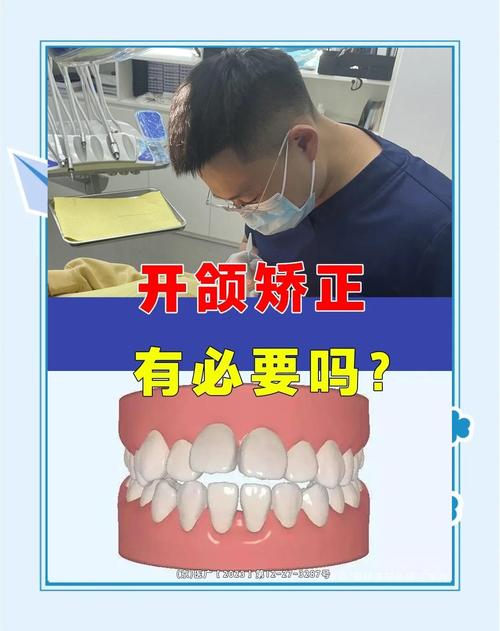 正畸开颌怎么矫正?有哪些方法?效果和周期如何?-图2 正畸开颌怎么矫正?有哪些方法?效果和周期如何?-图2