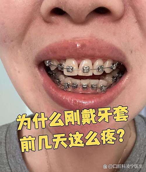 正畸牙齿加力痛吗-图3 正畸牙齿加力痛吗-图3