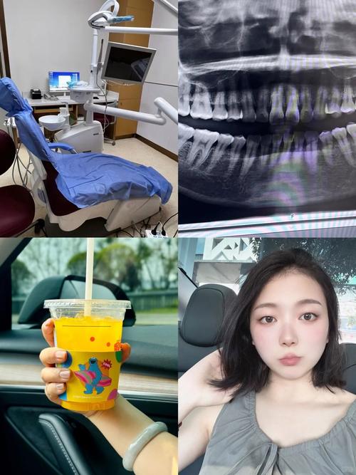 正畸可以拍牙片吗-图2 正畸可以拍牙片吗-图2