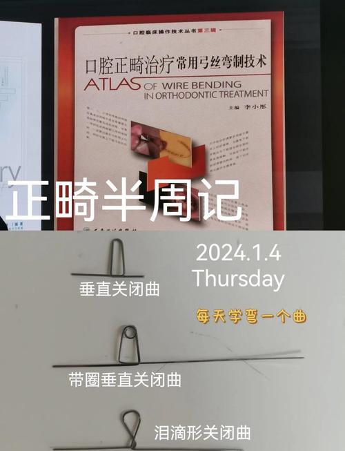 正畸开大曲是什么-图3