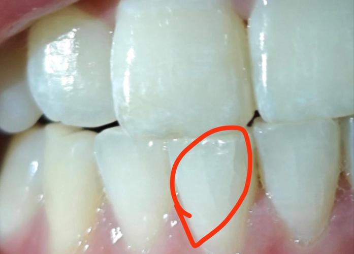 正畸牙后出现裂纹-图1