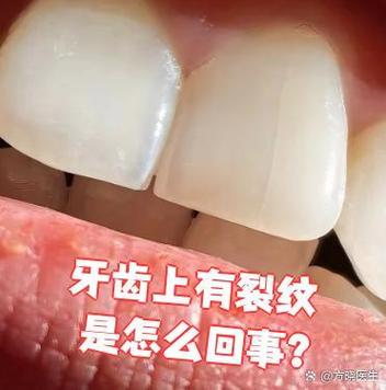 正畸牙后出现裂纹-图2