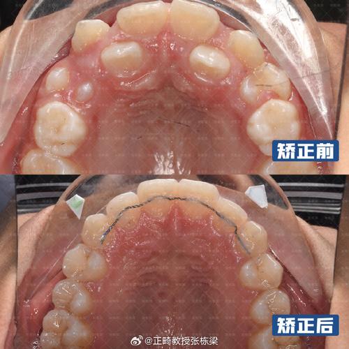 正畸大牙受力前移,这正常吗?为何会这样?-图3 正畸大牙受力前移,这正常吗?为何会这样?-图3