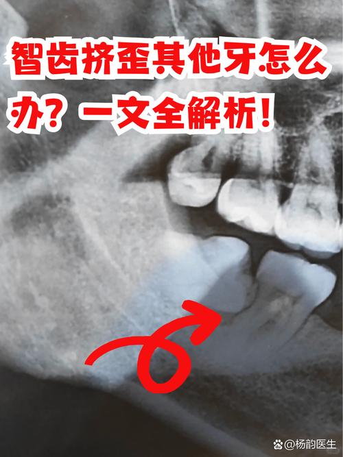 正畸中智齿的影响-图2