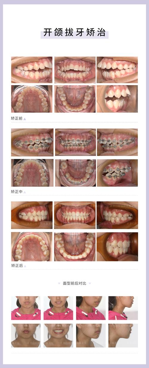 开合牙齿正畸过程-图1