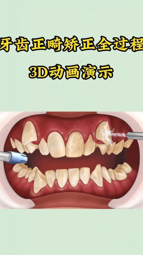 开合牙齿正畸过程-图3