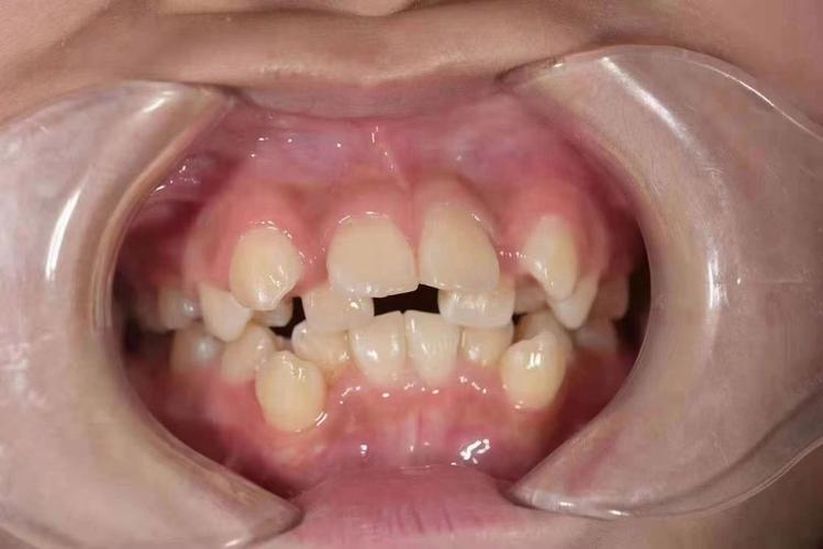 正畸大牙牙缝变大-图2