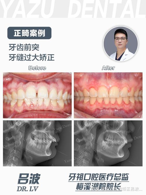 牙缝大正畸的方法-图2 牙缝大正畸的方法-图2