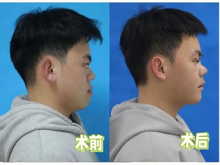 正畸张嘴下巴歪了-图3 正畸张嘴下巴歪了-图3