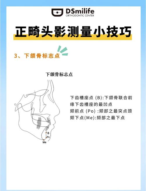 正畸治疗中头影测量如何正确操作与解读?-图1 正畸治疗中头影测量如何正确操作与解读?-图1