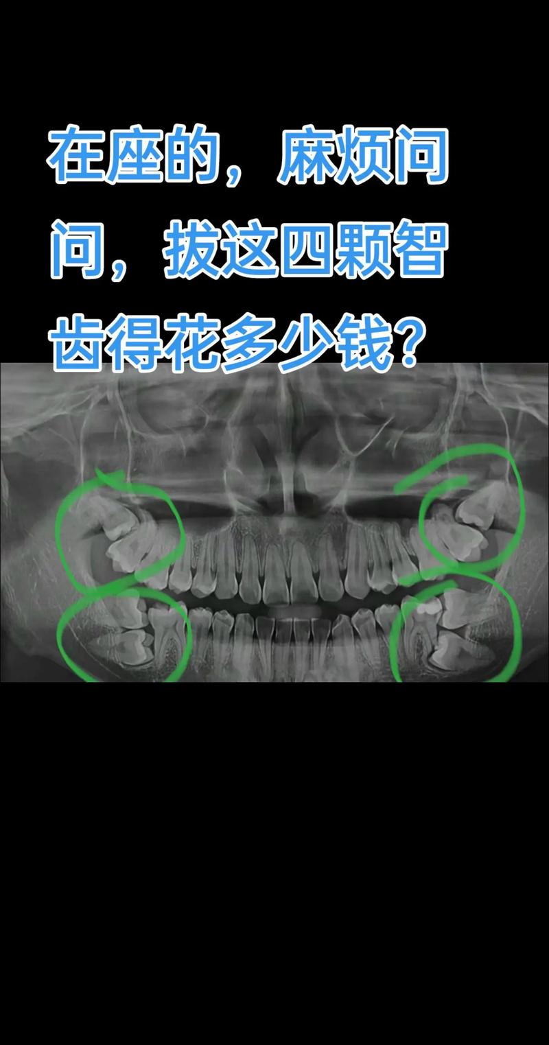 正畸拔4颗尖牙，真的有必要吗？-图1