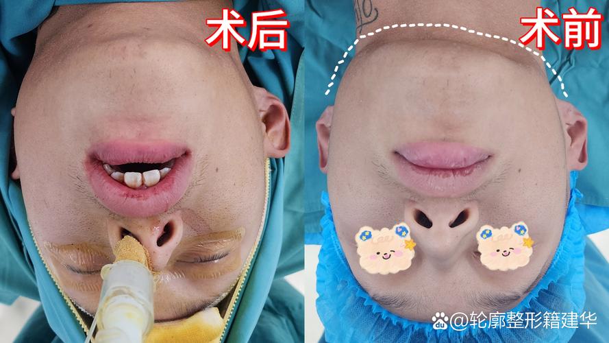 龅牙正畸正颌手术-图3