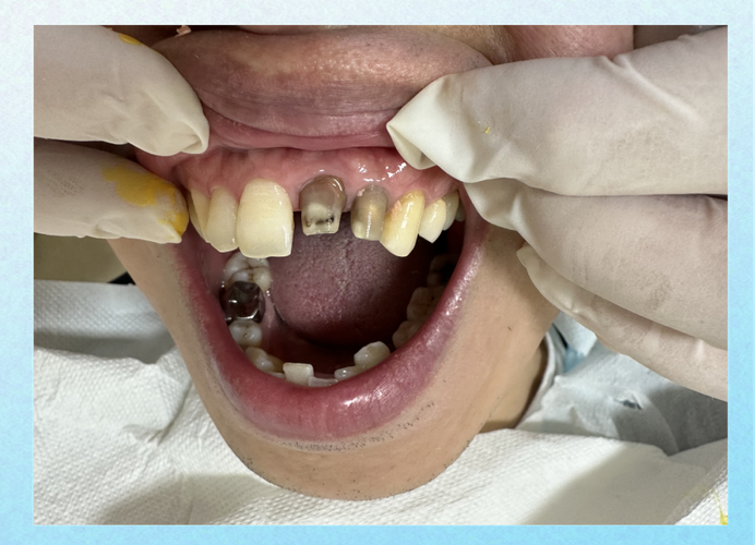 根管治疗后能正畸吗？时机与注意事项如何？-图1