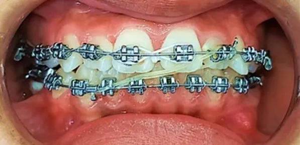 正畸牵引J钩断了怎么办？会影响矫正效果吗？-图3