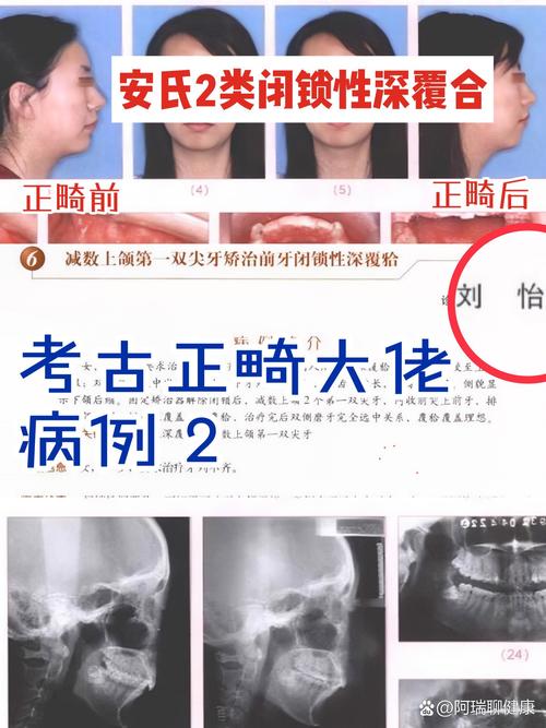 周医生正畸案例集藏着哪些牙齿矫正成功秘诀吗?-图2 周医生正畸案例集藏着哪些牙齿矫正成功秘诀吗?-图2