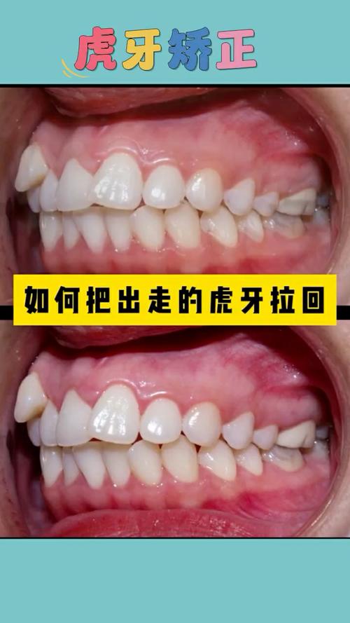 正畸虎牙到底要不要拔掉？-图1