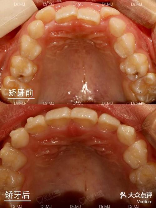 正畸第二磨牙倾斜因何发生?该如何有效应对?-图3 正畸第二磨牙倾斜因何发生?该如何有效应对?-图3