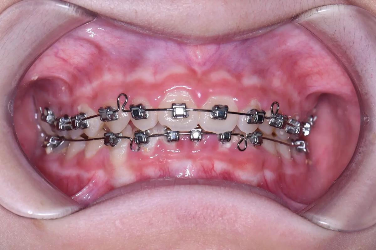 口腔O点表示正畸-图3