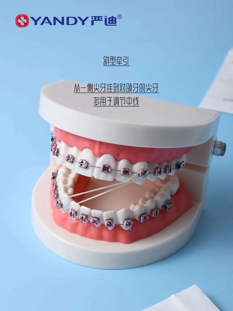 正畸牵引线是什么?矫正牙齿时它有何作用?-图1 正畸牵引线是什么?矫正牙齿时它有何作用?-图1