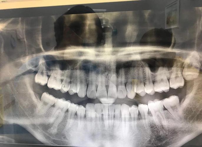 口腔正畸X光片有何关键作用?-图2 口腔正畸X光片有何关键作用?-图2