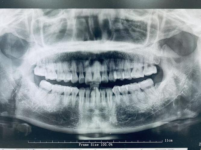 口腔正畸X光片有何关键作用?-图3 口腔正畸X光片有何关键作用?-图3