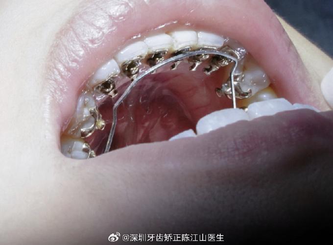 后牙舌侧倾斜正畸-图3