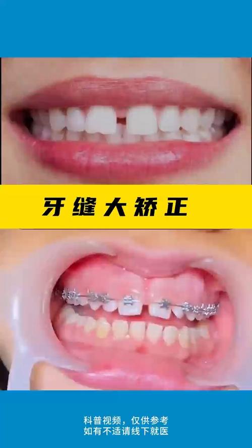 正畸后牙缝隙变大？原因何在？如何应对？-图3