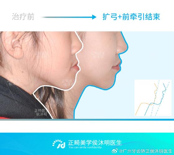 正畸末端回弯程度-图2