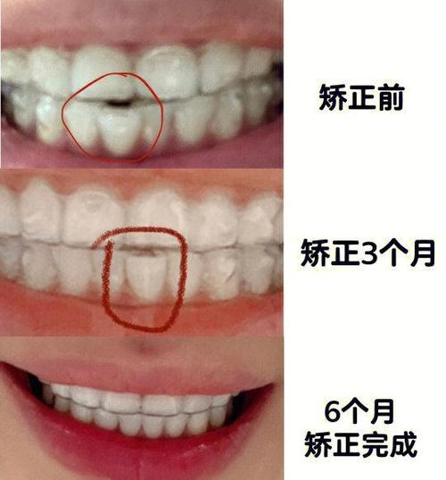 隐形正畸口扫几次-图2