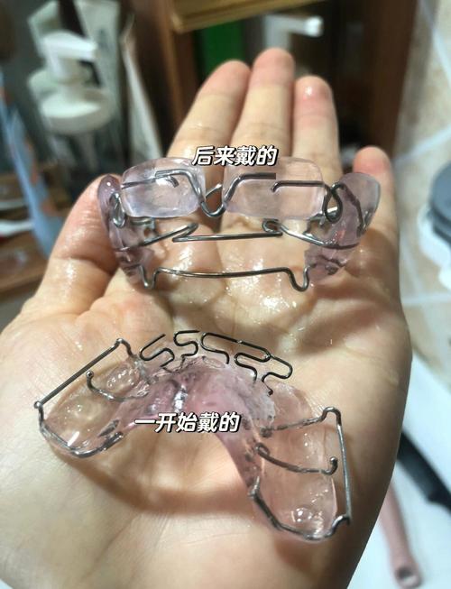 正畸牙齿上为何要加弹簧？作用原理是什么？-图2