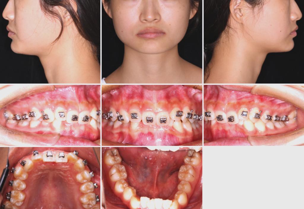 正畸安氏分类病例中,不同类型的临床特征与矫治策略差异?-图1 正畸安氏分类病例中,不同类型的临床特征与矫治策略差异?-图1