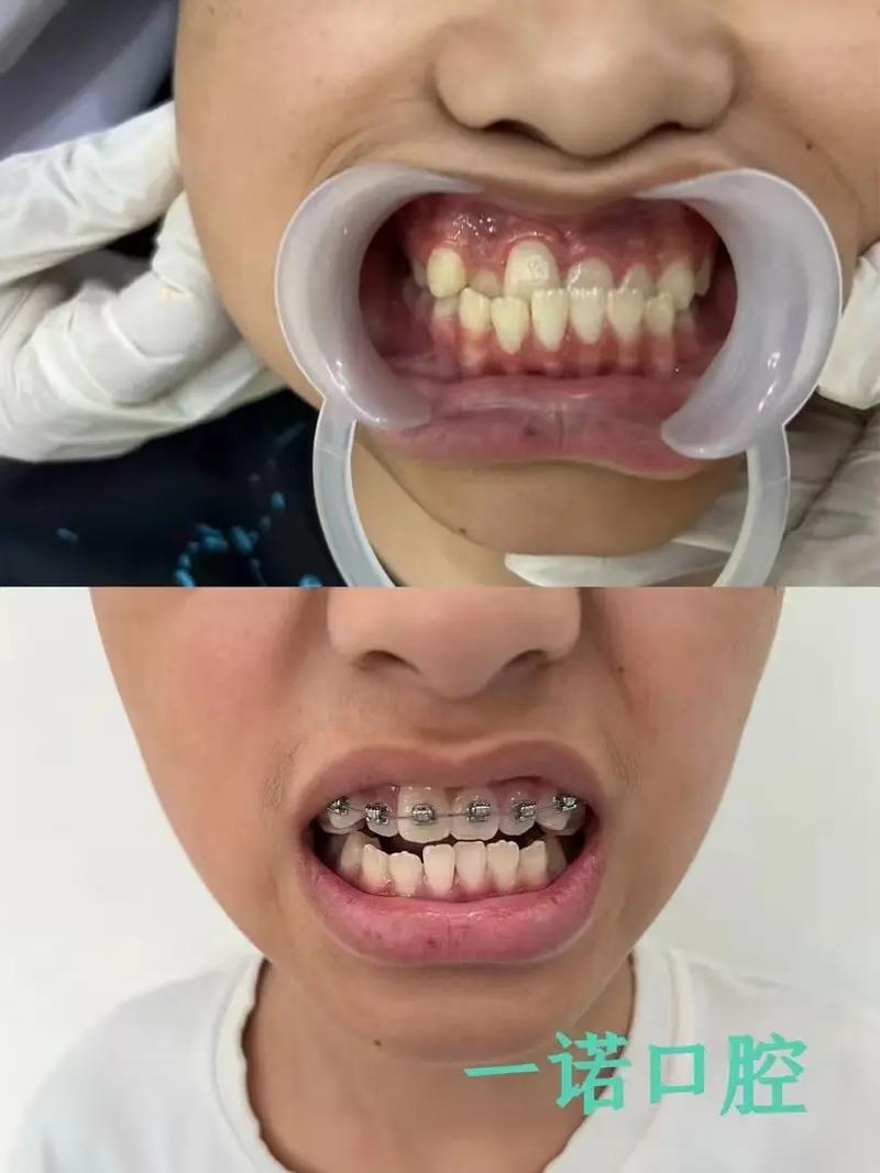 儿童龅牙看正畸科-图2