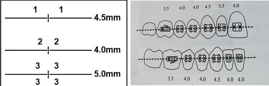 正畸托槽如何区分?材质外观功能看这里-图2 正畸托槽如何区分?材质外观功能看这里-图2