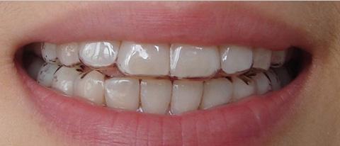 牙科诊所隐形正畸-图3