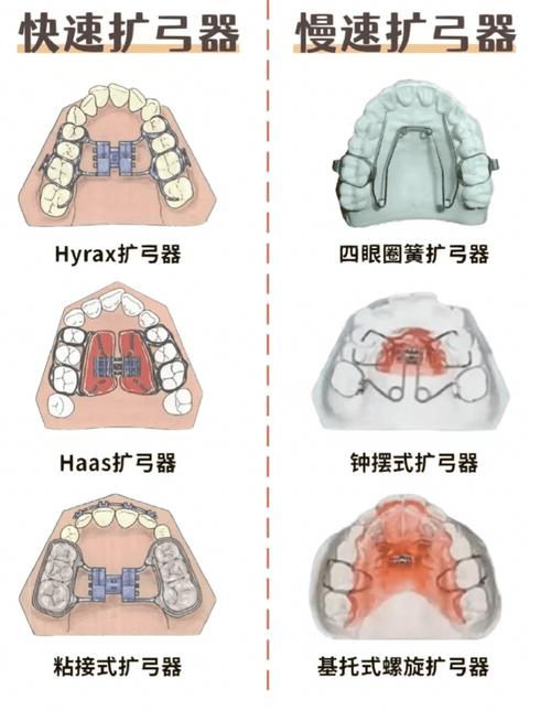 正畸中弓形的确定-图2
