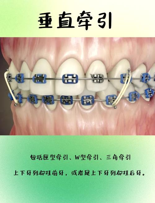 直丝正畸加力的正确操作步骤和方法有哪些?-图2 直丝正畸加力的正确操作步骤和方法有哪些?-图2