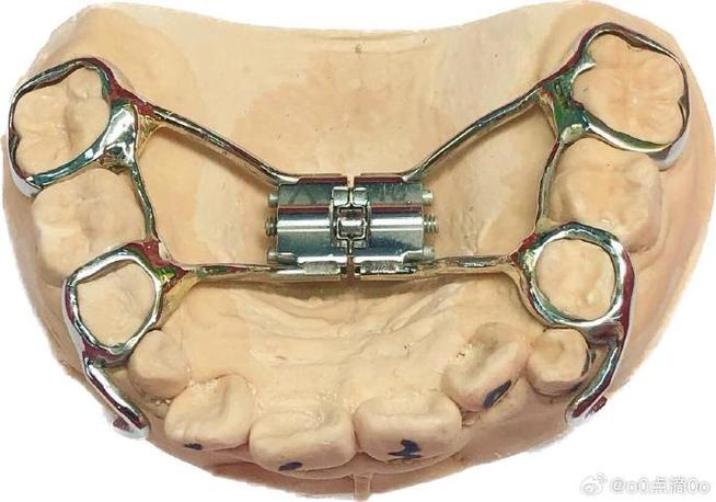 进口前牵装置正畸效果怎样?适合骨性畸形矫正吗?-图2 进口前牵装置正畸效果怎样?适合骨性畸形矫正吗?-图2