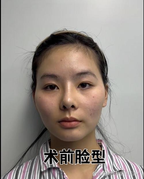 正畸会使颧骨变高-图2 正畸会使颧骨变高-图2