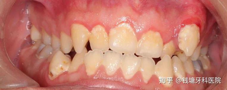 瑞泰口腔正畸效果如何?真实体验值得信赖吗?-图3 瑞泰口腔正畸效果如何?真实体验值得信赖吗?-图3