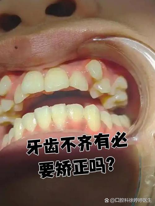 口腔正畸如何有效矫正牙列不齐?-图3 口腔正畸如何有效矫正牙列不齐?-图3