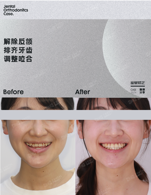 反颌正畸拔牙，矫正的必要选择还是无奈之举？-图2