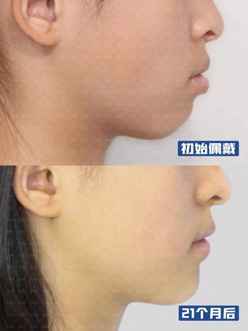 下颌后缩正畸案例，矫正方法有哪些？效果如何？关键点是什么？-图1