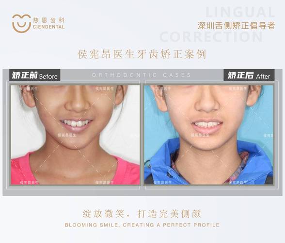 骨突正畸完美病例，效果真的无可挑剔吗？-图2