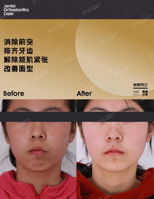 骨突正畸完美病例，效果真的无可挑剔吗？-图1