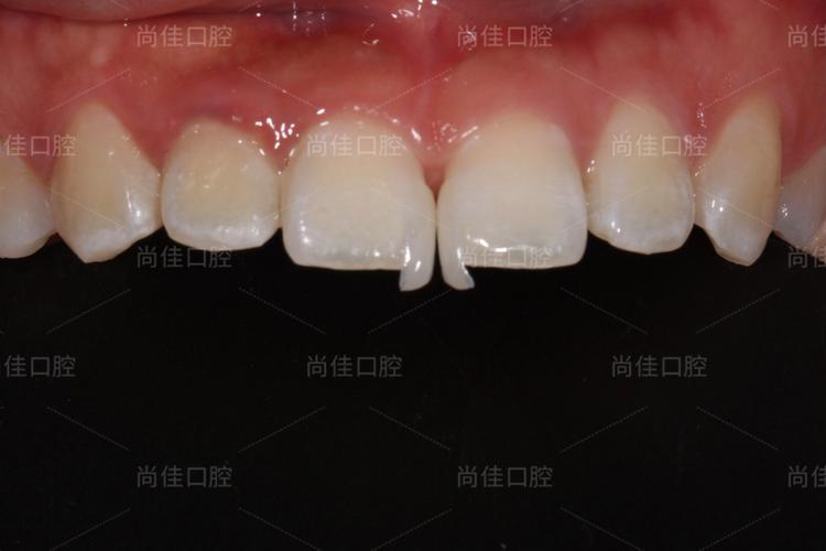 正畸N年后大牙缝，是矫正问题还是其他原因？-图2